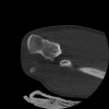 SPORK, NICO - 22.03.1976 - 02.08.2022 - CT obere Extremität - 17:51:17